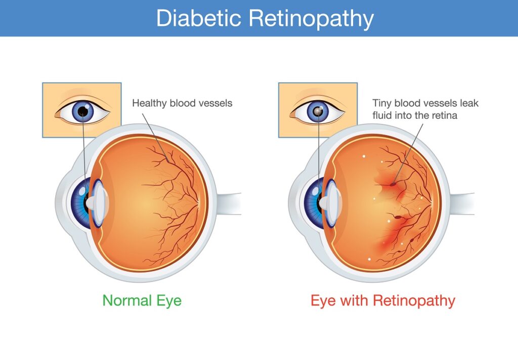 DiabeticRetinopathy