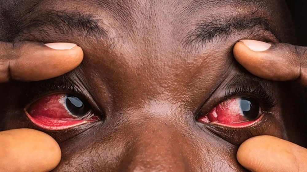 RedEye