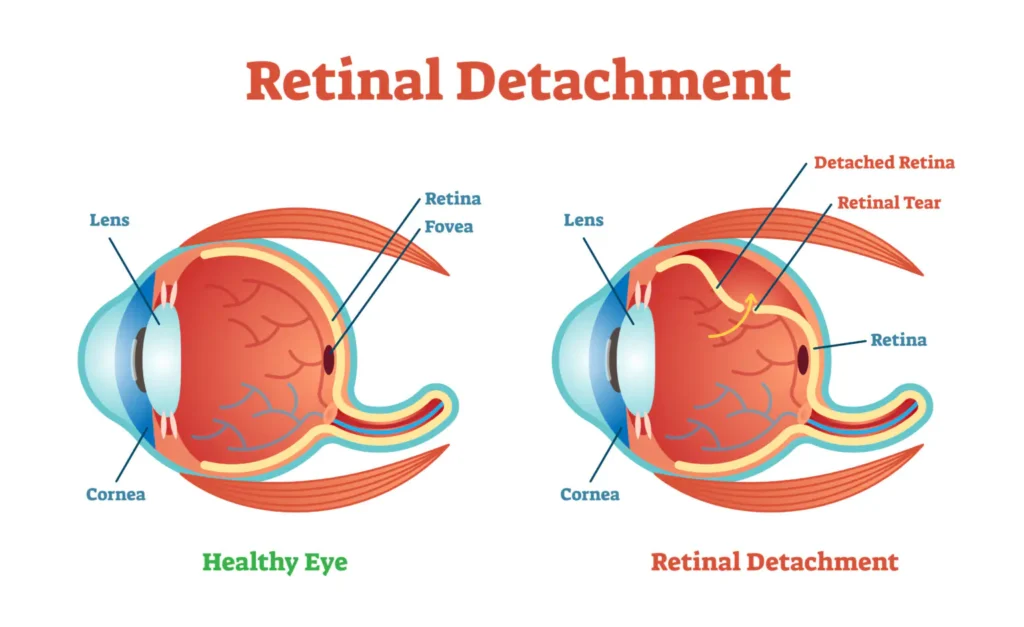 Retinal-Detachment-1536x941.jpg