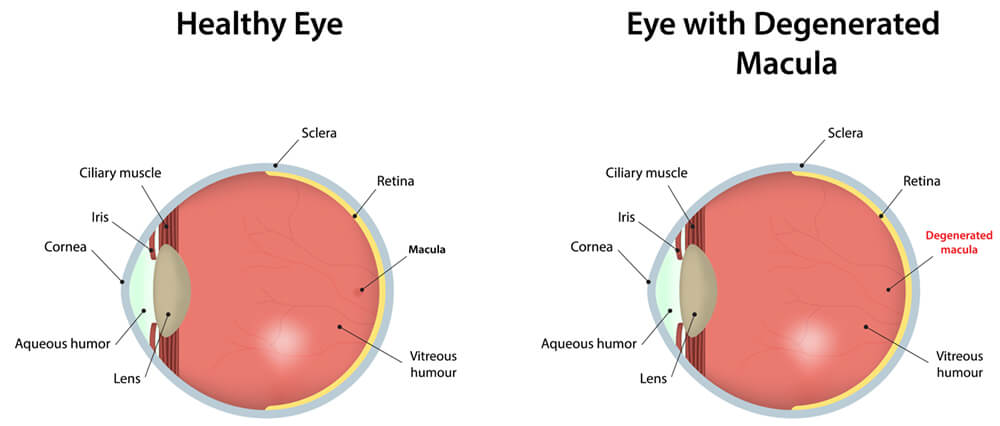 macular-degeneration-chart